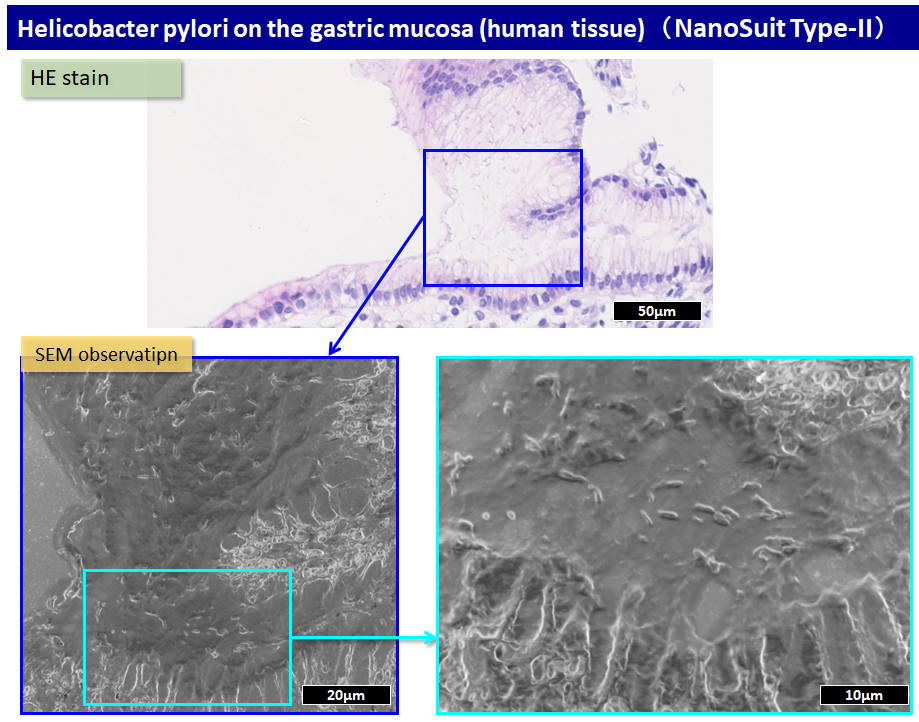 helicobacter pylori